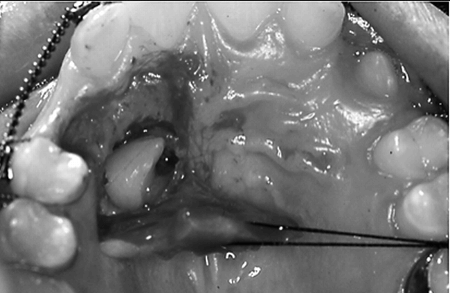 Figure 4. Surgical exposure of the impacted canine (flap approach) following the increase of the upper arch perimeter